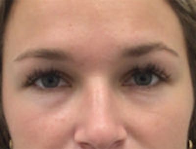 Botox Browlift Before & After Gallery - Patient 269652 - Image 1