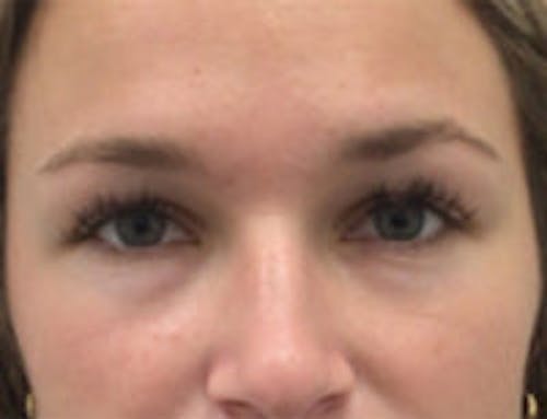 Botox Brow Lift Before & After Gallery - Patient 269652 - Image 1
