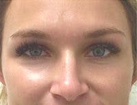 Botox Brow Lift Before & After Gallery - Patient 269652 - Image 2