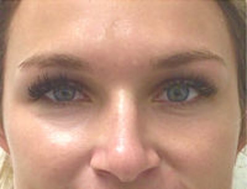 Botox Browlift Before & After Gallery - Patient 269652 - Image 2