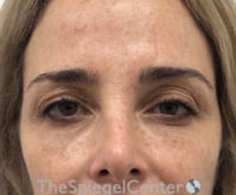 Botox Browlift Before & After Gallery - Patient 308285 - Image 1