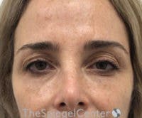 Botox Brow Lift Before & After Gallery - Patient 308285 - Image 1