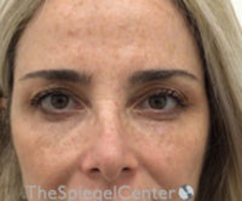Botox Browlift Before & After Gallery - Patient 308285 - Image 2