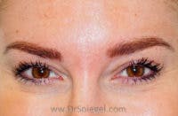 Botox Brow Lift Before & After Gallery - Patient 748705 - Image 1