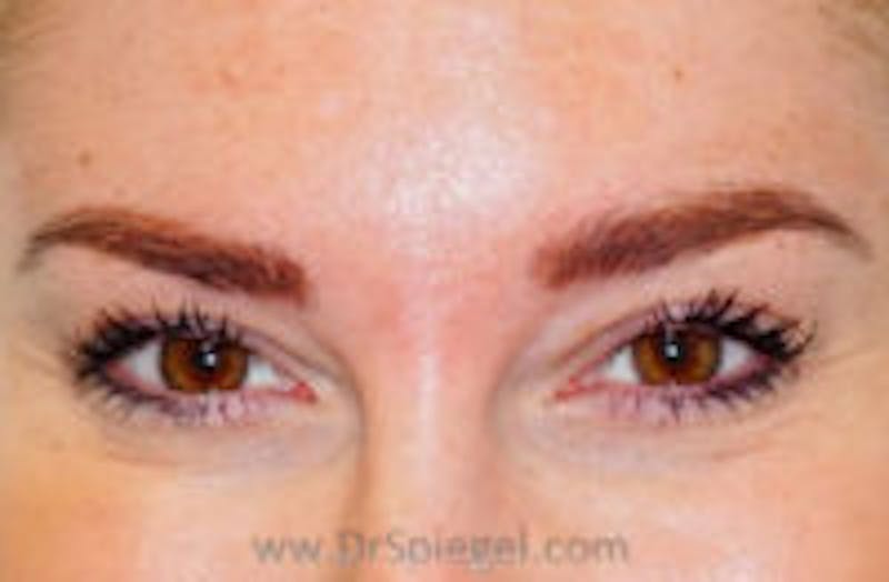 Botox Browlift Before & After Gallery - Patient 748705 - Image 1