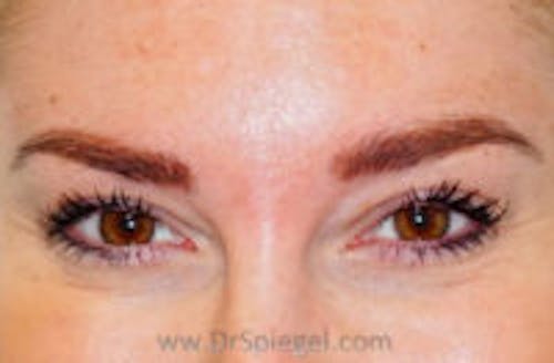 Botox Brow Lift Before & After Gallery - Patient 748705 - Image 1