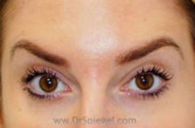 Botox Browlift Before & After Gallery - Patient 748705 - Image 2