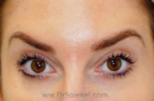 Botox Brow Lift Before & After Gallery - Patient 748705 - Image 2