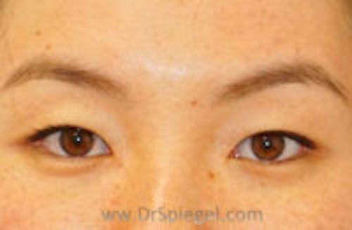 Botox Brow Lift Before & After Gallery - Patient 198721 - Image 1