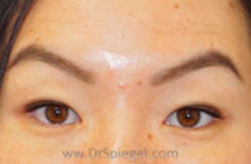 Botox Brow Lift Before & After Gallery - Patient 198721 - Image 2