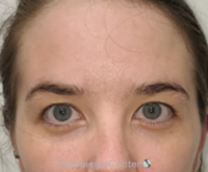 Botox Browlift Before & After Gallery - Patient 423565 - Image 1