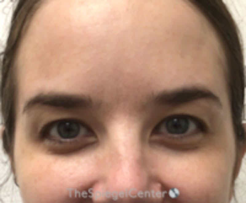 Botox Browlift Before & After Gallery - Patient 423565 - Image 2