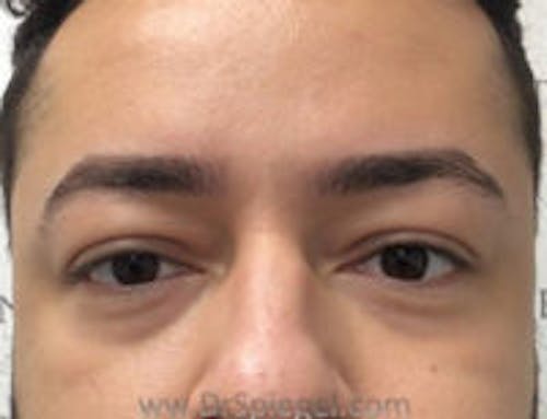 Botox Brow Lift Before & After Gallery - Patient 216624 - Image 1
