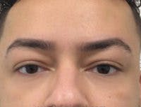 Botox Brow Lift Before & After Gallery - Patient 216624 - Image 2