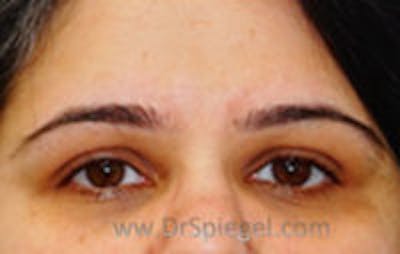 Botox Browlift Before & After Gallery - Patient 232285 - Image 1