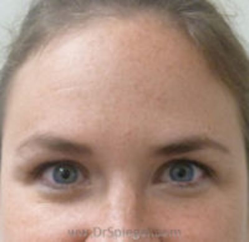 Botox Browlift Before & After Gallery - Patient 390723 - Image 1
