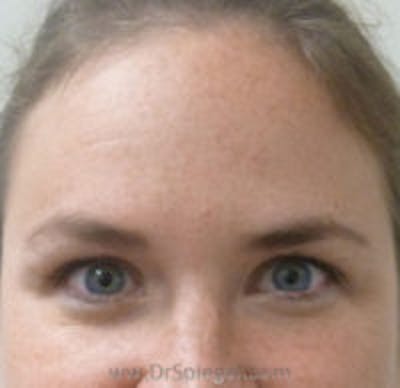 Botox Browlift Before & After Gallery - Patient 390723 - Image 1