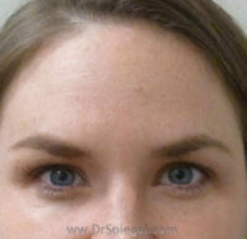 Botox Browlift Before & After Gallery - Patient 390723 - Image 2