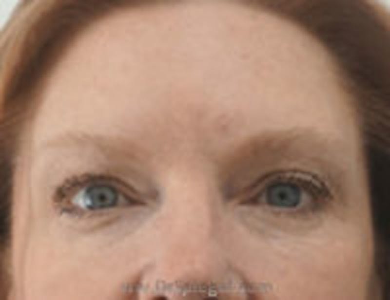Botox Browlift Before & After Gallery - Patient 867149 - Image 2