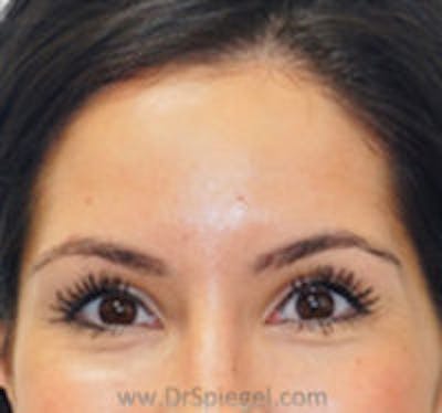 Botox Browlift Before & After Gallery - Patient 231765 - Image 1