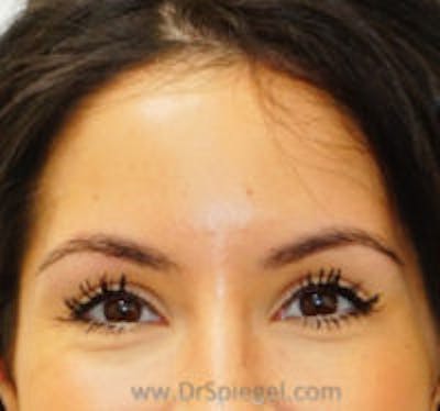 Botox Browlift Before & After Gallery - Patient 231765 - Image 2
