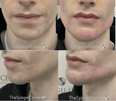 Chin Filler Before & After Gallery - Patient 827522 - Image 1