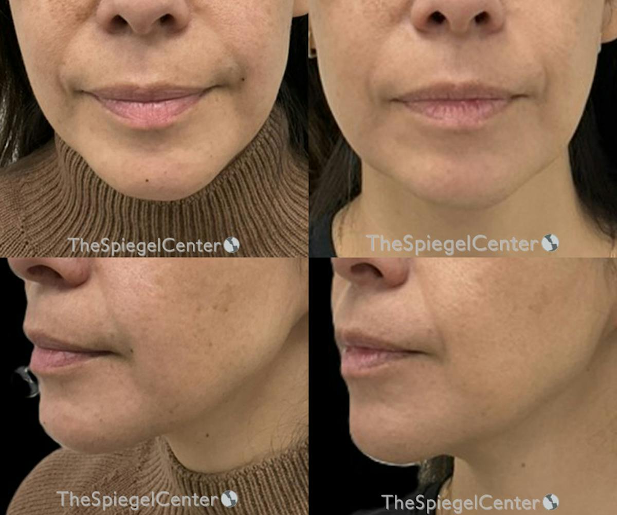 Chin Filler Before & After Gallery - Patient 257982 - Image 1