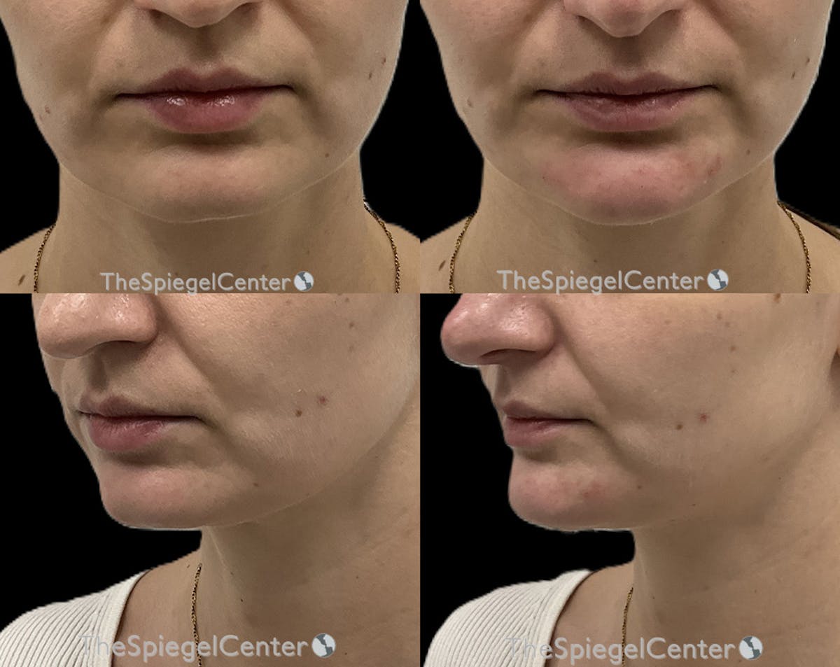 Chin Filler Before & After Gallery - Patient 144015 - Image 1