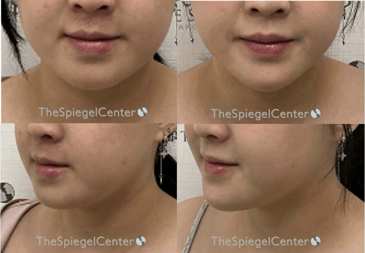 Chin Filler Before & After Gallery - Patient 286040 - Image 1