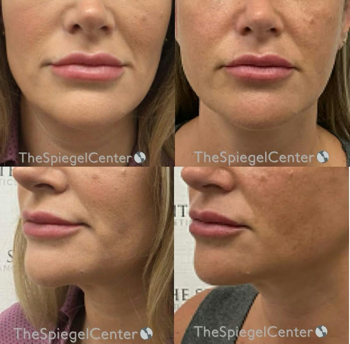 Chin Filler Before & After Gallery - Patient 395767 - Image 1