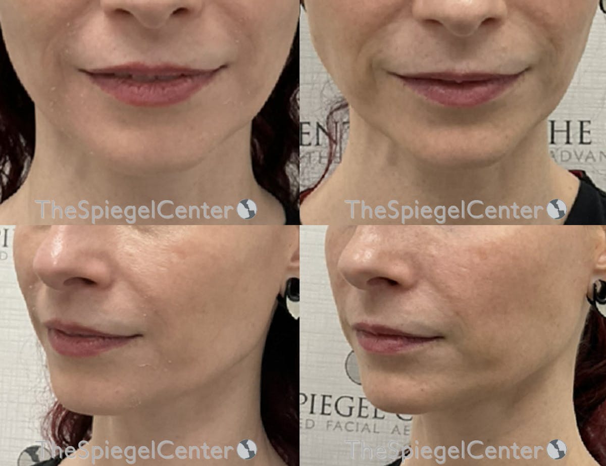 Chin Filler Before & After Gallery - Patient 342665 - Image 1