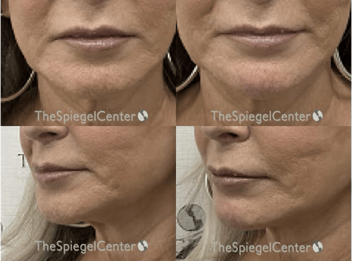 Chin Filler Before & After Gallery - Patient 103274 - Image 1