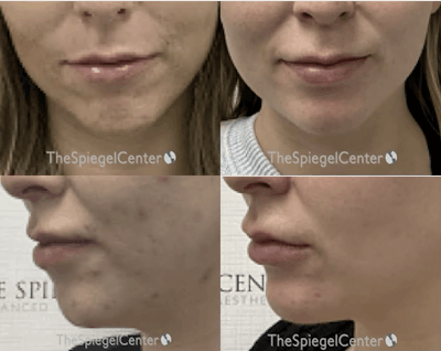 Chin Filler Before & After Gallery - Patient 119042 - Image 1