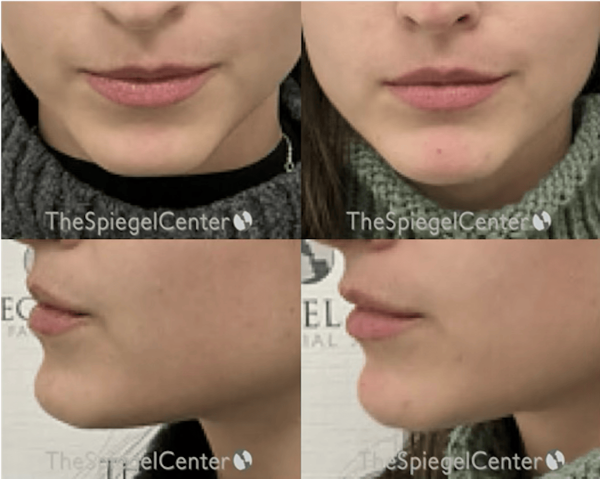 Chin Filler Before & After Gallery - Patient 142683 - Image 1