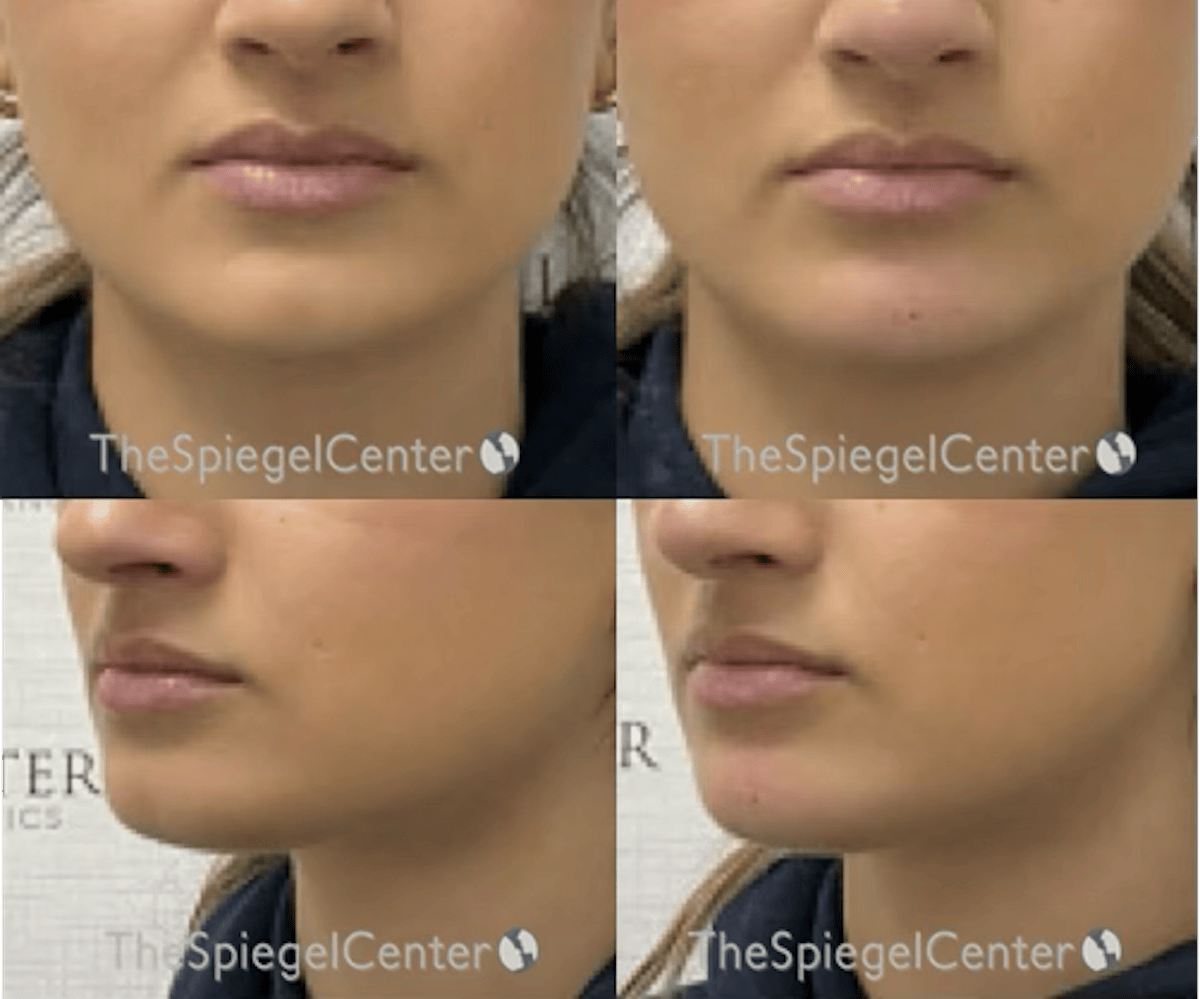 Chin Filler Before & After Gallery - Patient 176921 - Image 1