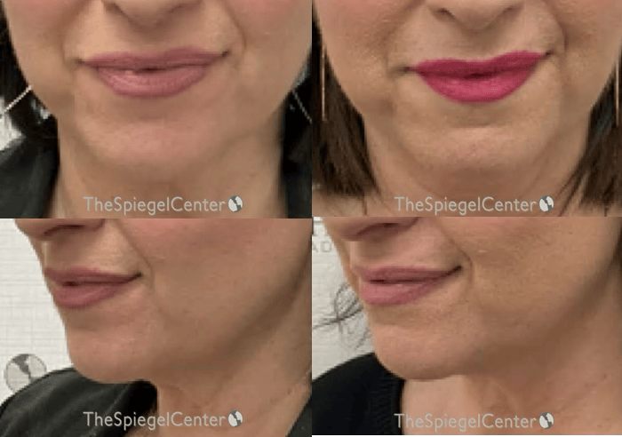 Chin Filler Before & After Gallery - Patient 262988 - Image 1