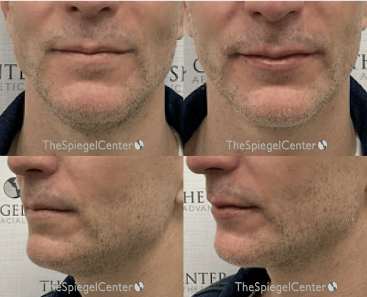 Chin Filler Before & After Gallery - Patient 309131 - Image 1