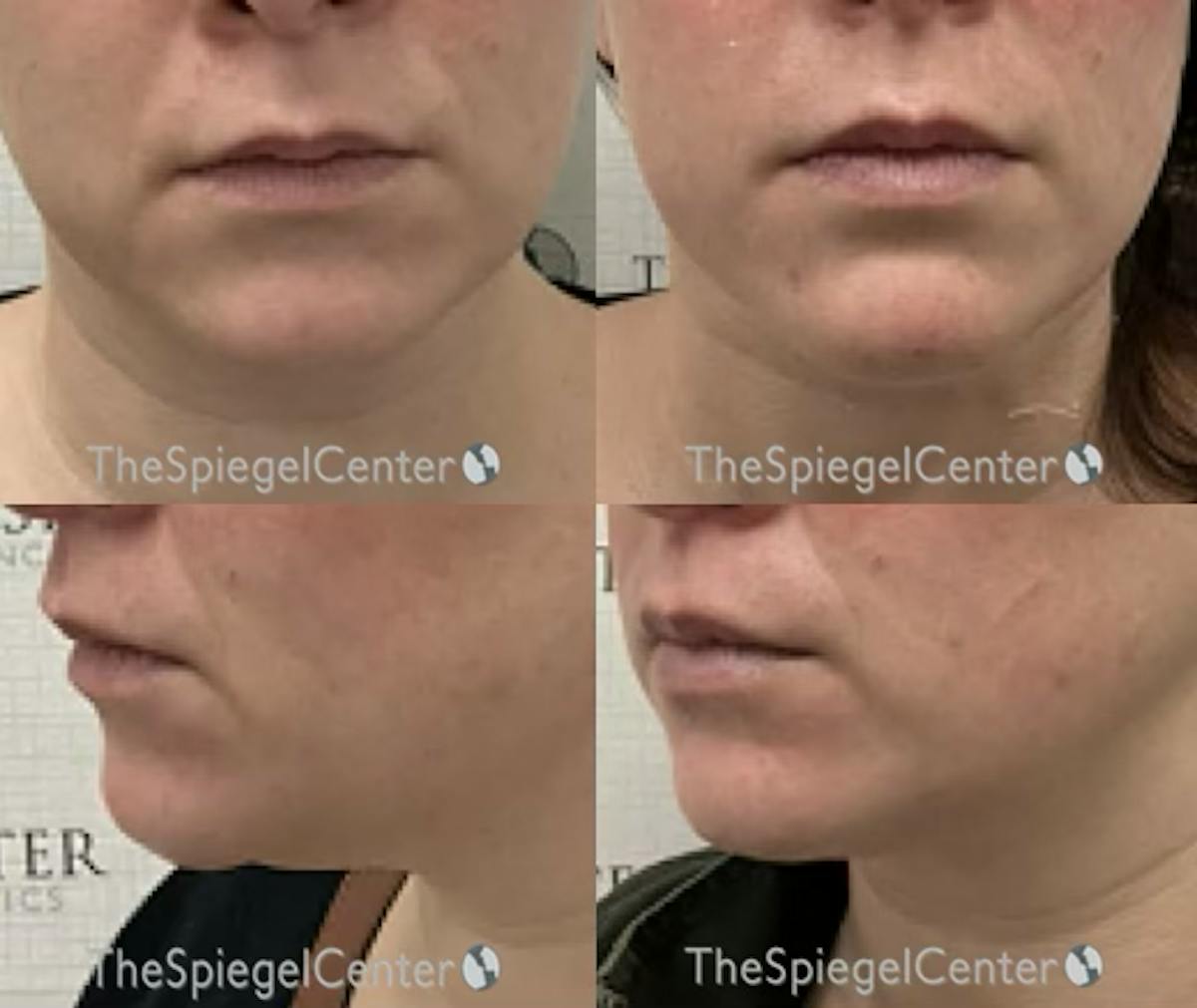 Chin Filler Before & After Gallery - Patient 151593 - Image 1
