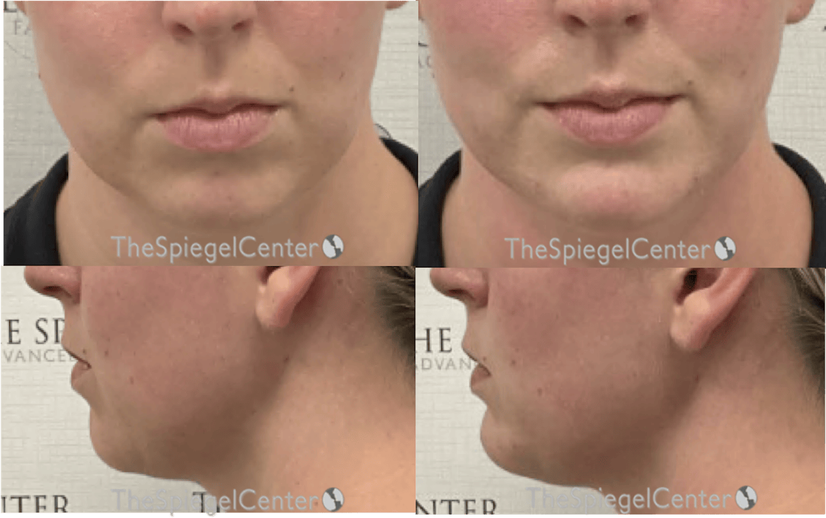 Chin Filler Before & After Gallery - Patient 305576 - Image 1