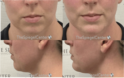 Chin Filler Before & After Gallery - Patient 305576 - Image 1