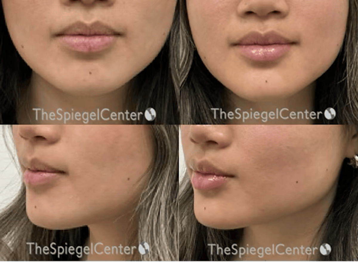 Chin Filler Before & After Gallery - Patient 654276 - Image 1