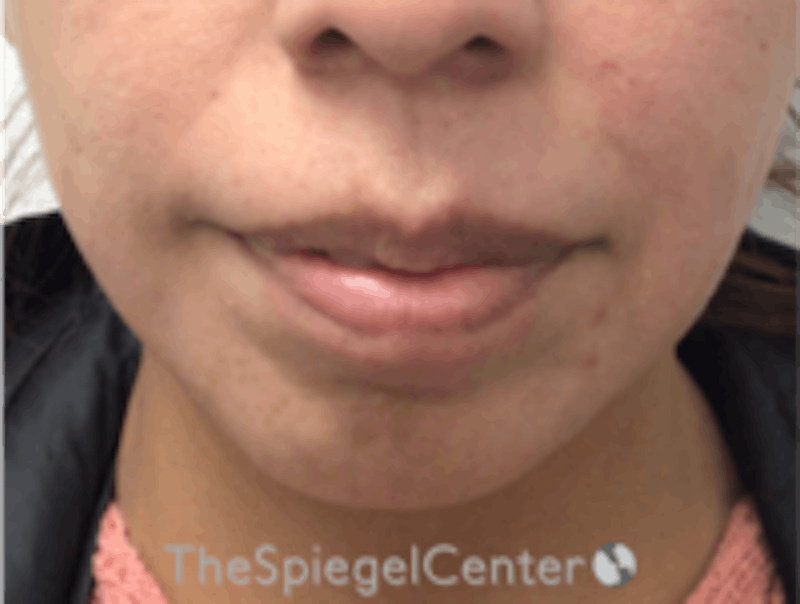 Chin Filler Before & After Gallery - Patient 813047 - Image 1