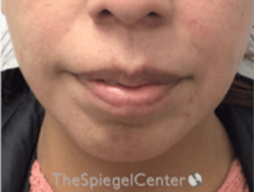 Chin Filler Before & After Gallery - Patient 813047 - Image 1