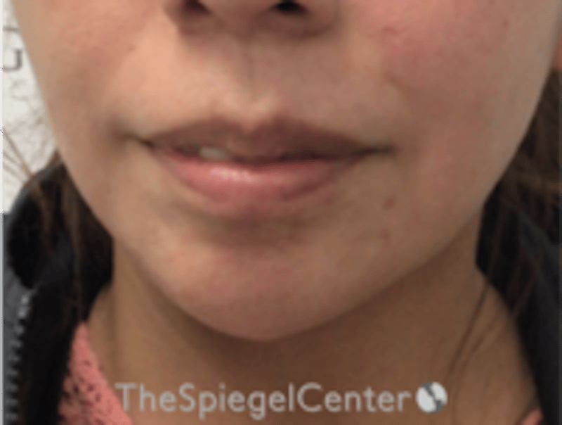Chin Filler Before & After Gallery - Patient 813047 - Image 2