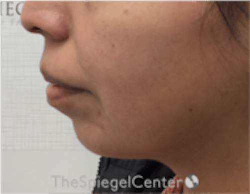 Chin Filler Before & After Gallery - Patient 813047 - Image 3