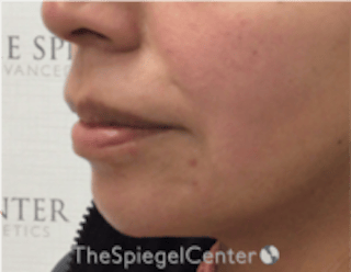 Chin Filler Before & After Gallery - Patient 813047 - Image 4