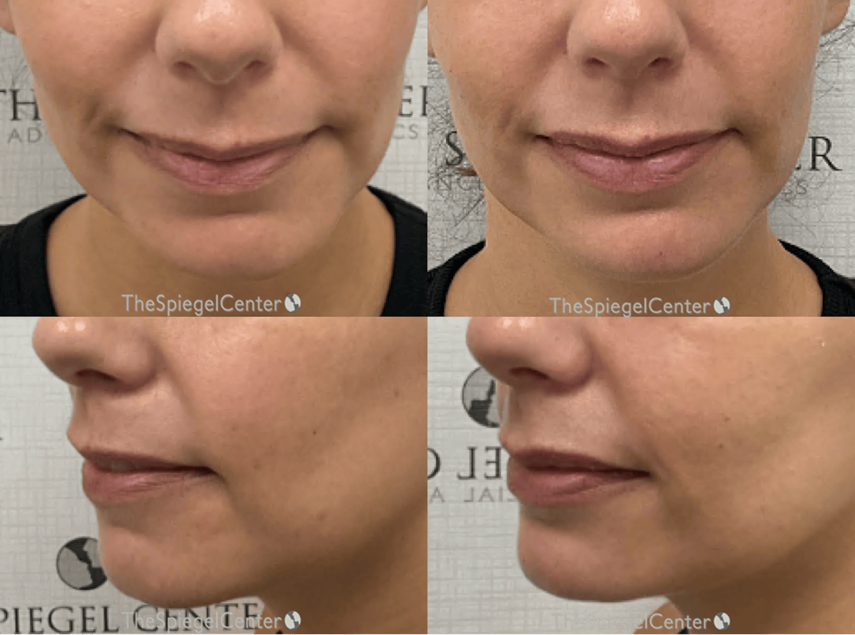 Chin Filler Before & After Gallery - Patient 414745 - Image 1