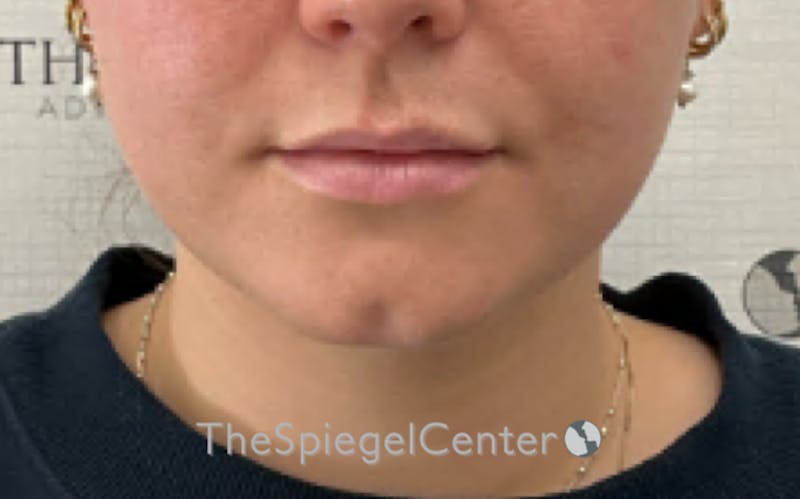 Chin Filler Before & After Gallery - Patient 535729 - Image 1