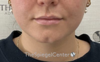 Chin Filler Before & After Gallery - Patient 535729 - Image 1