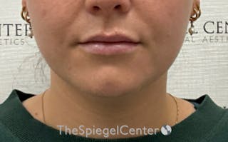 Chin Filler Before & After Gallery - Patient 535729 - Image 2